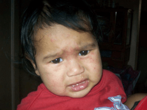 Rosa Maria Cabrera, 4 years old, is from El Pedernal. Her mother is very worried. “Look. This is occurring again. Look at her little face. You should see how she scratches, and more in the night-time. The doctor tells us that for her to get better, we need to bathe her in water from elsewhere. But we are poor. Where can we go? We will die here for the contamination that Entremares has left us, … and they say it will be like this for a long time. May God take care of us.”